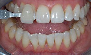 Blanchiment dentaire avant le traitement dentaire par le Dr Noureddine Kadi